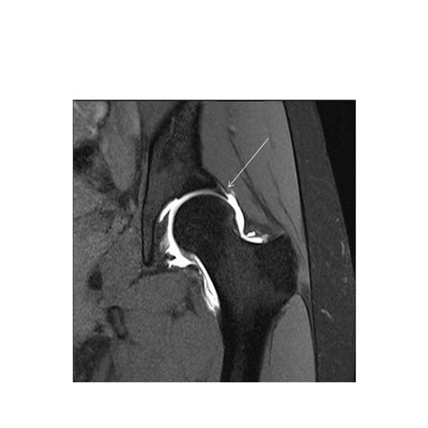 Coronal Mr Arthrography T1 Fat Saturation Image Of Hip Depicts