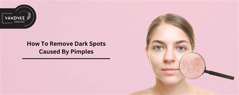 How To Remove Dark Spots Caused By Pimples Skincare Product