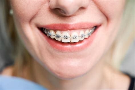 Myths About Getting Braces As An Adult