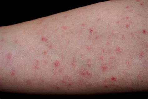Pityriasis Lichenoides Chronica Best Homeopathy Doctor In India Us