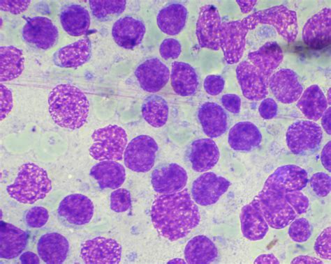 Aspiration Cytology Smear Of A Diffuse Large B Cell Lymphoma Showing