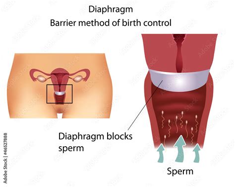 Barrier Contraceptive Method Diaphragm Stock Vektorgrafik Adobe Stock