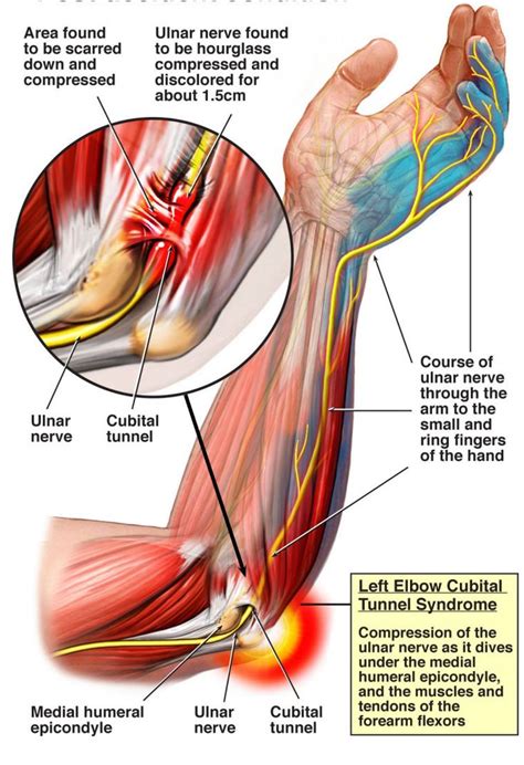 Cubital Tunnel Syndrome Compression Of The Ulnar Nerve As It Dives