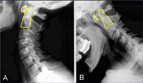 Atlantoaxial Instability Spine Orthobullets