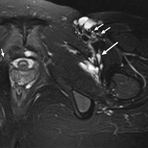 High Resolution 3 T Mr Neurography Of Femoral Neuropathy Ajr