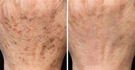 Age Spots On Hands Reasons And Quick Removal Tips Skincarederm