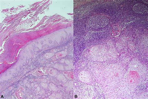 Aggressive Cutaneous Squamous Cell Carcinoma In A Patient With Klick