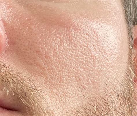 Skin Concerns Help With Skin Texture Part 2 Rskincareaddiction