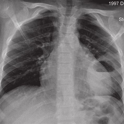 A Plain Chest Radiograph Showing A Thick Walled Cavity With Air Fluid