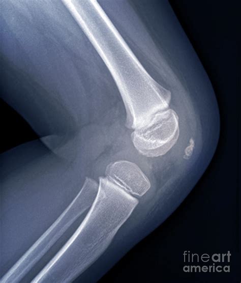 Knee Of A Child Photograph By Zephyrscience Photo Library Pixels