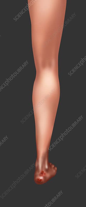 Bed Sores Illustration Stock Image F0317116 Science Photo Library
