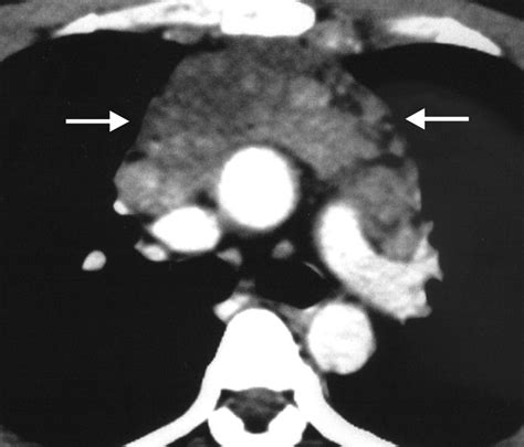 Castleman Disease Contrast Enhanced Chest Ct Scan Shows Matted