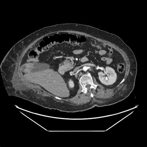 Trousseau Syndrome Gallbladder Carcinoma Presenting With Bilateral