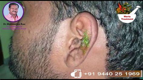 Warts Treatment In Ear Diagnosis And Symptoms Srisaila Ayurvedic