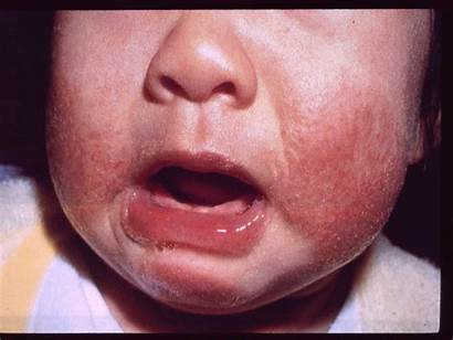 Eczema Face Cheeks Toddler Children Treatment Rash