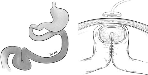 Figure 1 From The Omega Jejunostomy Tube A Preferred Alternative For