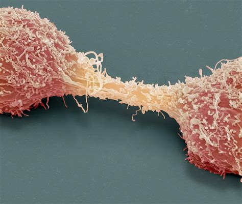 Dividing Brain Cancer Cells Sem Photograph By Steve Gschmeissner