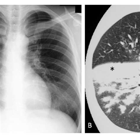 Mycoplasma Pneumoniae Pneumonia In Human A Chest X Ray Shows