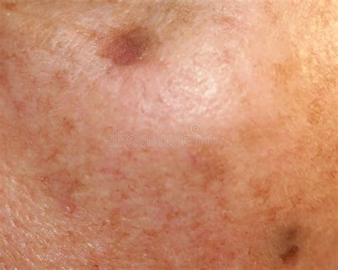 Skin Pigmentation Brown Spots Of Pigmentation On The Skin Of The Face