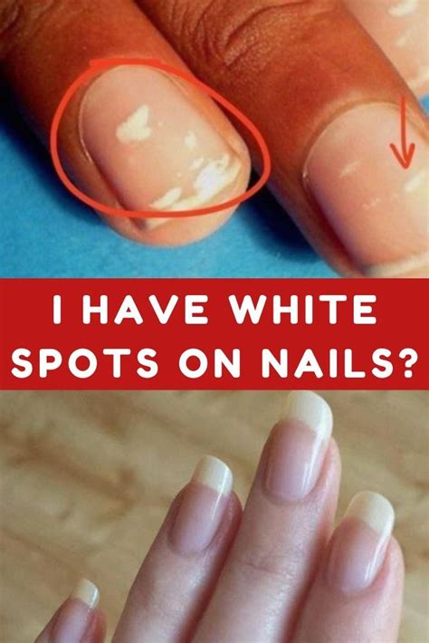 Famous What Are White Spots On Your Nails A Sign Of Ideas Fsabd42