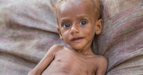 Malnutrition Symptoms Causes Treatments Optimists Healthcare India
