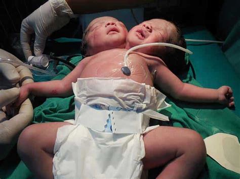 Very Very Rare Conjoined Twins Delivered At Haryana Hospital