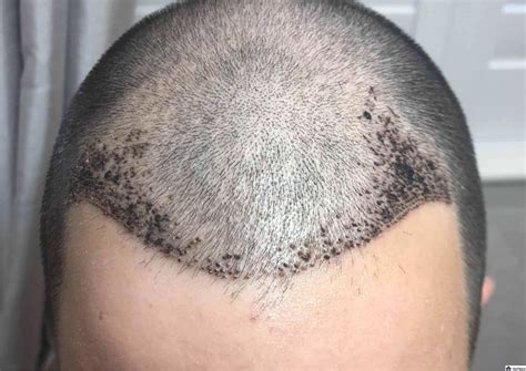 Hair Transplant After 7 Days Photos Results And Aftercare