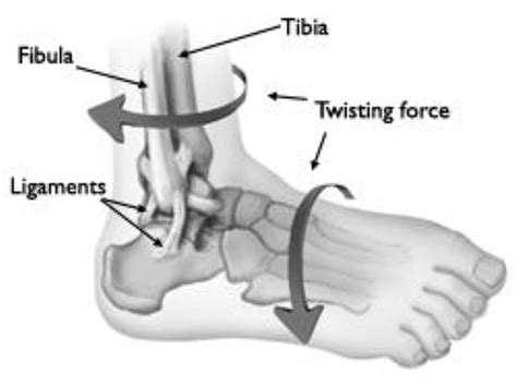 Ankle Fractures In Children Orthoinfo Aaos