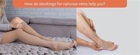 Varicose Treatment In Pune Karishma Vein Clinic Varicose Flickr