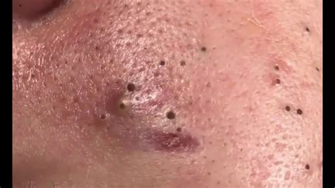 How To Remove Blackhead And How To Get Rid Blackhead Youtube