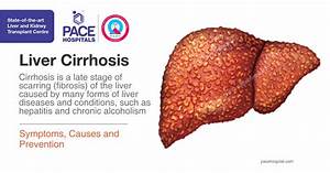 Liver Cirrhosis - Symptoms, Causes and Prevention Cirrhosis  