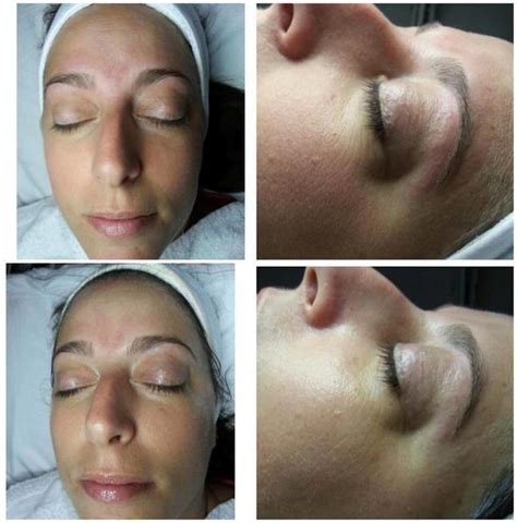 Microcurrent Facial Before And After Photos 5 Facelift