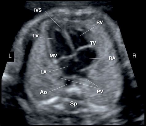 Cardiac Chambers The Four Chamber And Short Axis Views Obgyn Key