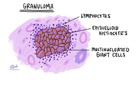 Granuloma Mypathologyreportca