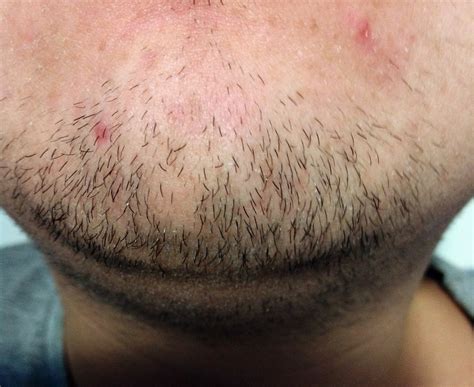 Шелушится кожа на бороде и выпадают волосы у мужчин причины что делать