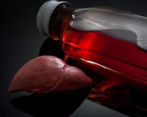 Alcoholic Hepatitis Vs Cirrhosis Fatty Liver Disease
