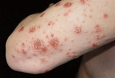 Severe Generalized Nummular Eczema Secondary To Interferon Alfa 2b Plus Ribavirin Combination