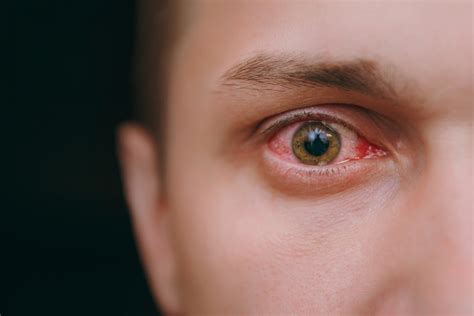 Herpes infection of the cornea - Harvard Health Blog - Harvard Health