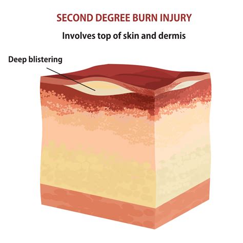 Second Degree Burns Blister Burns Causes And Effects