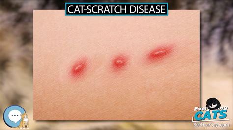 Cat Scratch Disease Causes Symptoms And Treatment Vlrengbr