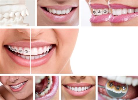 How Much Do Braces Cost Withwithout Insurance Headgear Braces