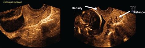 imaging of the uterine cervix radiology key