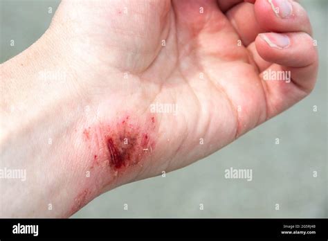 Burn Wound Treatment Hi Res Stock Photography And Images Alamy