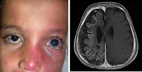 Sturge Weber Syndrome And Its Manifestations In Skin Brain Medizzy