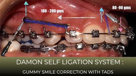 Lecture 8 Gummy Smile Correction With Damon System And Mini Implants
