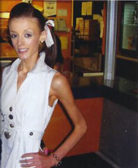 Recovering Anorexic Tells How One Cruel Comment From An Ex Led To An