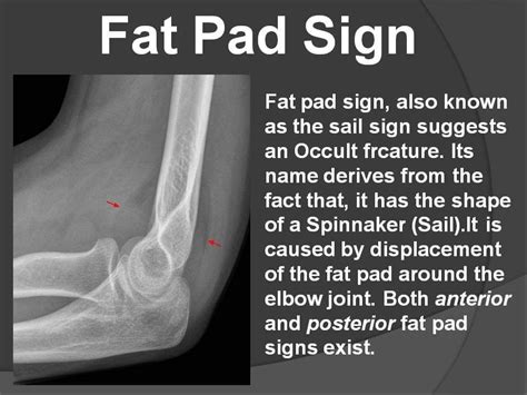 Fat Pad Sign Supracondylar Fracture Is The Commonest Cause In