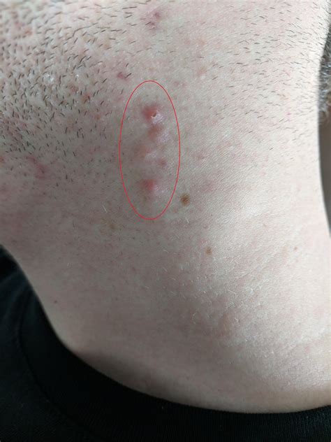 Large Pimples On Neck Wont Go Away Recommendations Racne