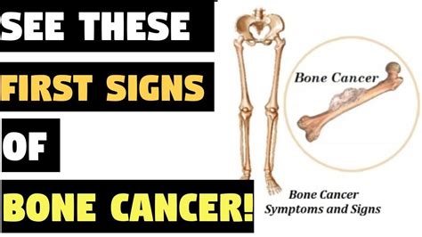 If You See These First Signs You Are Developing Bone Cancer Youtube