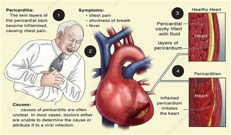 Pericarditis Symptoms Pathophysiology Causes Diagnosis And The Best Porn Website